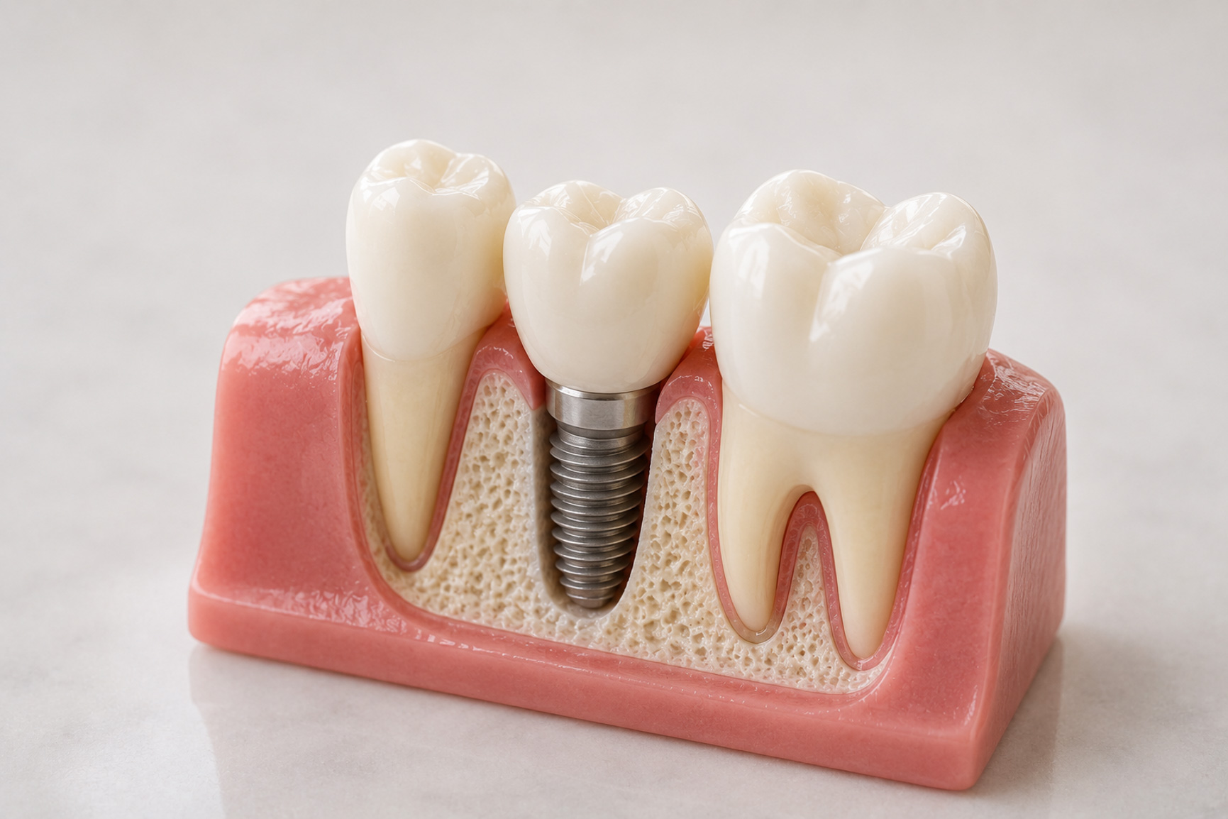 Dental implant model for missing tooth replacement