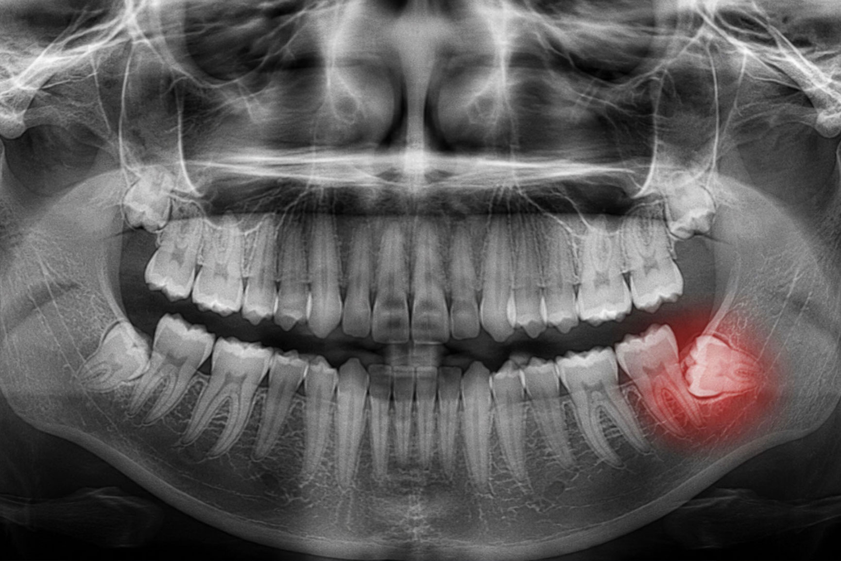 Tooth extractions at Wandermere Family Dentistry